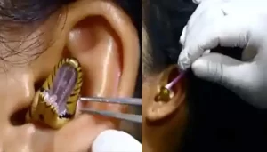 snake entered inside the girl's ear 