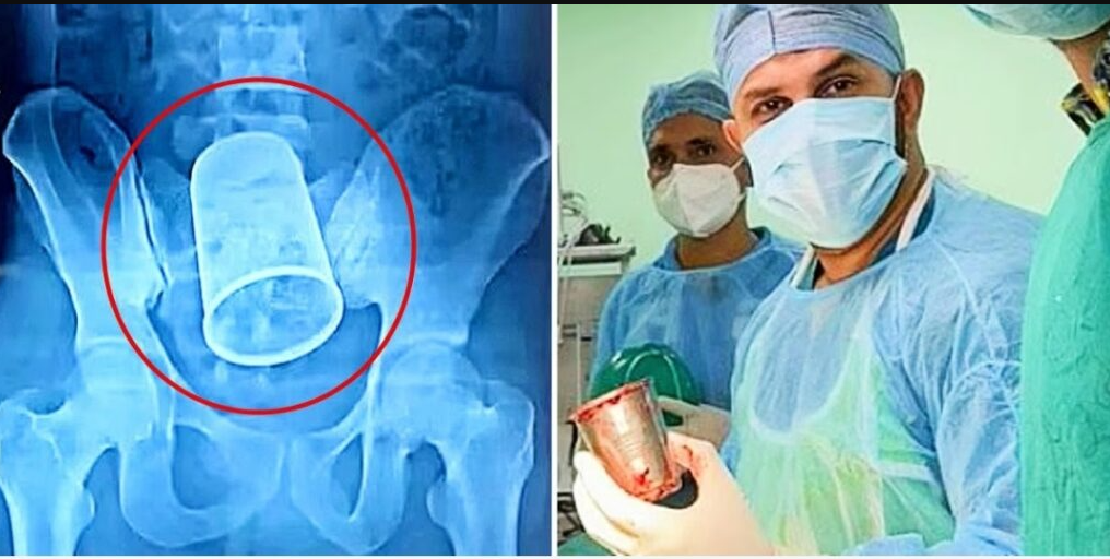 drunk-22-year-boy-gets-a-5-5-inch-long-steel-cup-removed-from-his-stimach