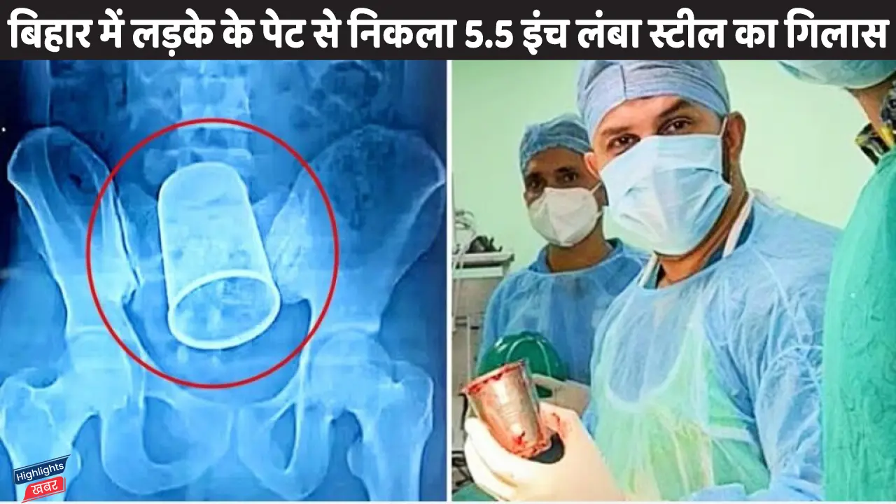 drunk-22-year-boy-gets-a-5-5-inch-long-steel-cup-removed-from-his-stimach