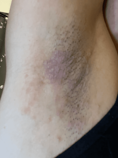 know-the-best-way-to-avoid-underarm-itching-and-infection