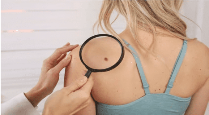 know what is the meaning of mole on these special body parts of women 