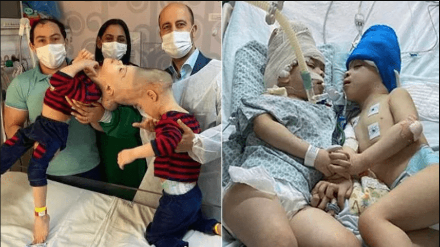 these-children-were-attached-to-the-headdoctors-separated-them-by-operation